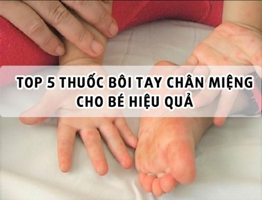 Top 5 thuốc bôi tay chân miệng cho bé hiệu quả nhất