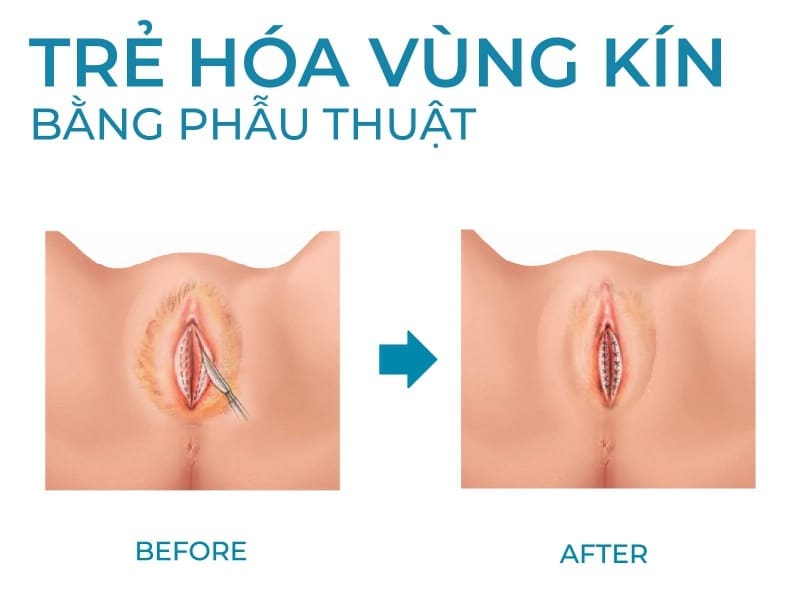 Những điều cần biết về trẻ hoá vùng kín, phụ nữ nào cũng nên rõ