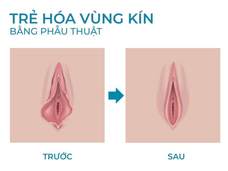 Những điều cần biết về trẻ hoá vùng kín, phụ nữ nào cũng nên rõ
