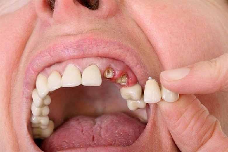 Mơ thấy rụng răng đánh con gì? Giải mã giấc mơ chính xác! 